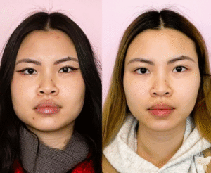 Botox for Jawline Slimming after and before transformation