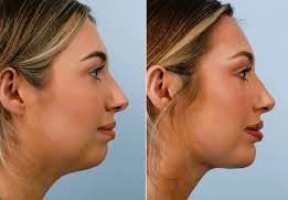 Chin Augmentation of an women before and after transformation
