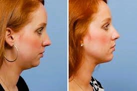 Chin & Neck Liposuction after and before transformation of an women face and jawline