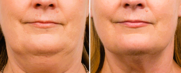 coolsculpting in women face after and before transformation